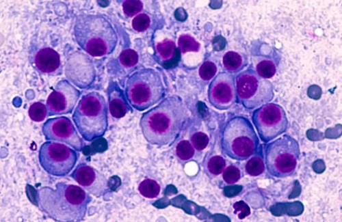 Mayo Clinic cancer expert highlights advancements in treating multiple myeloma