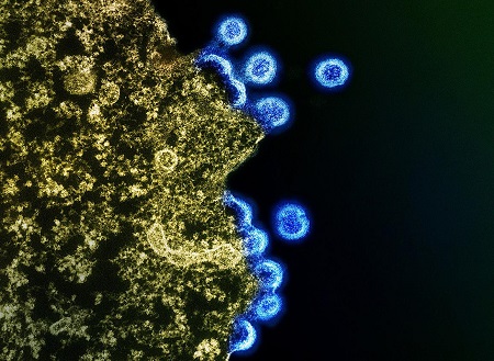 Tools underestimate cardiovascular event risk in people with HIV