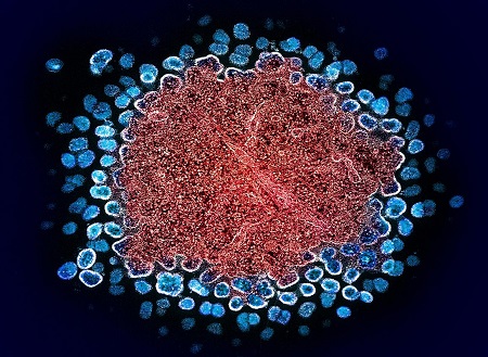 Long-acting HIV treatment benefits adults with barriers to daily pill taking and adolescents with suppressed HIV