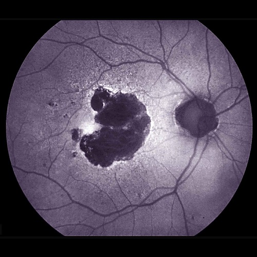 Inflammation-reducing drug shows no benefit for dry age-related macular degeneration in NIH trial