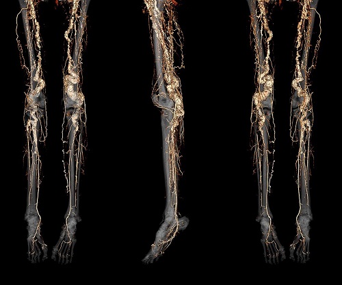 Drug shows promise for slowing progression of rare, painful genetic disease