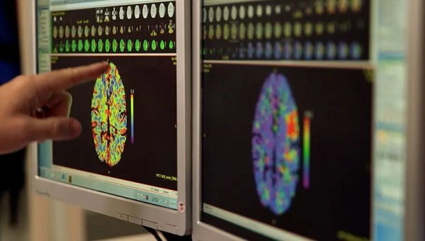 Expert alert: Procedure offers hope to patients living with physical changes from stroke, other conditions