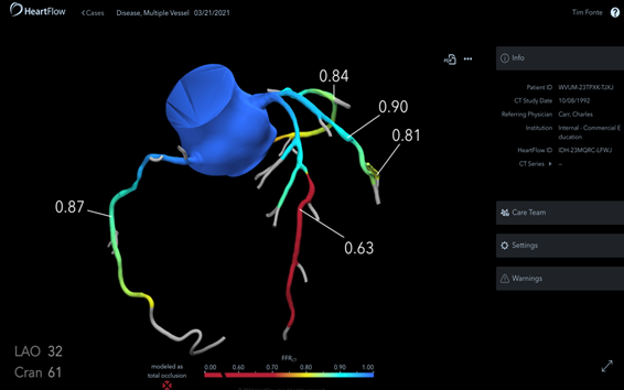 HCA Florida Mercy Hospital Adopts HeartFlow Analysis, a Novel Diagnostic Tool for Heart Disease