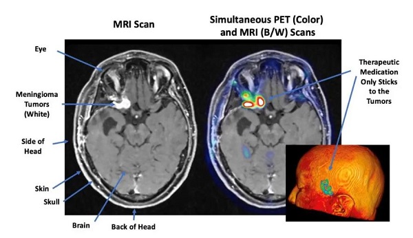 Radiopharmaceutical therapy shows favorable results for people with tough-to-treat meningioma brain tumors, Mayo Clinic study finds
