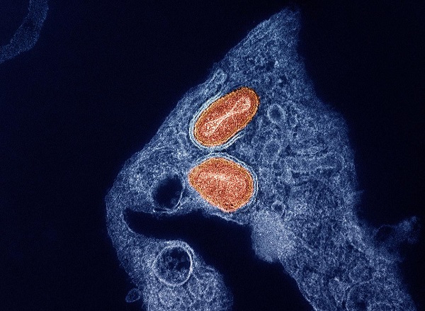 NIH Study Finds Tecovirimat Was Safe but Did Not Improve Mpox Resolution or Pain