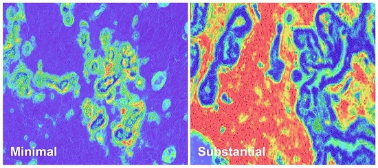 NIH researchers discover tissue biomarker that may indicate higher risk of aggressive breast cancer development and death