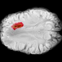 NIH-funded study suggests that testosterone suppresses brain tumor growth in males